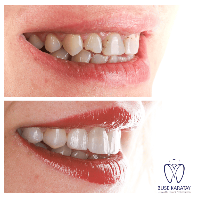 İzmir’in Işıltısını Gülüşünüze Taşıyın: Gülüş Tasarımı ve Estetik Diş Hekimliği